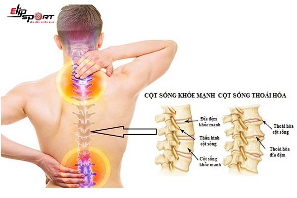bệnh tho&aacute;i h&oacute;a cột sống