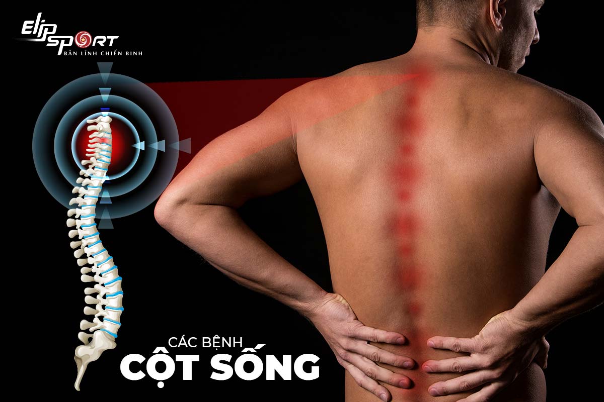 bệnh đau vai g&aacute;y