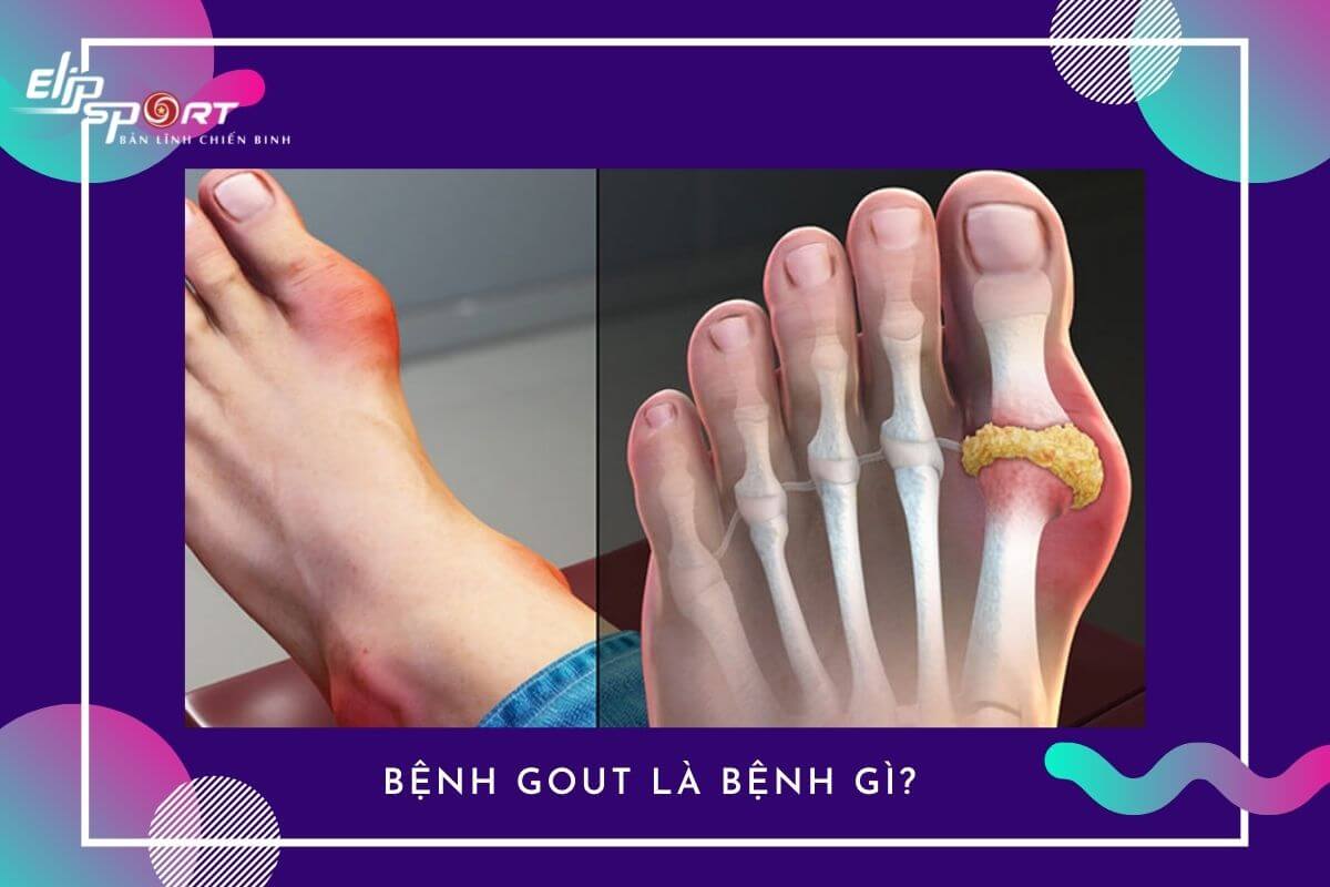 bị Gout nên làm gì