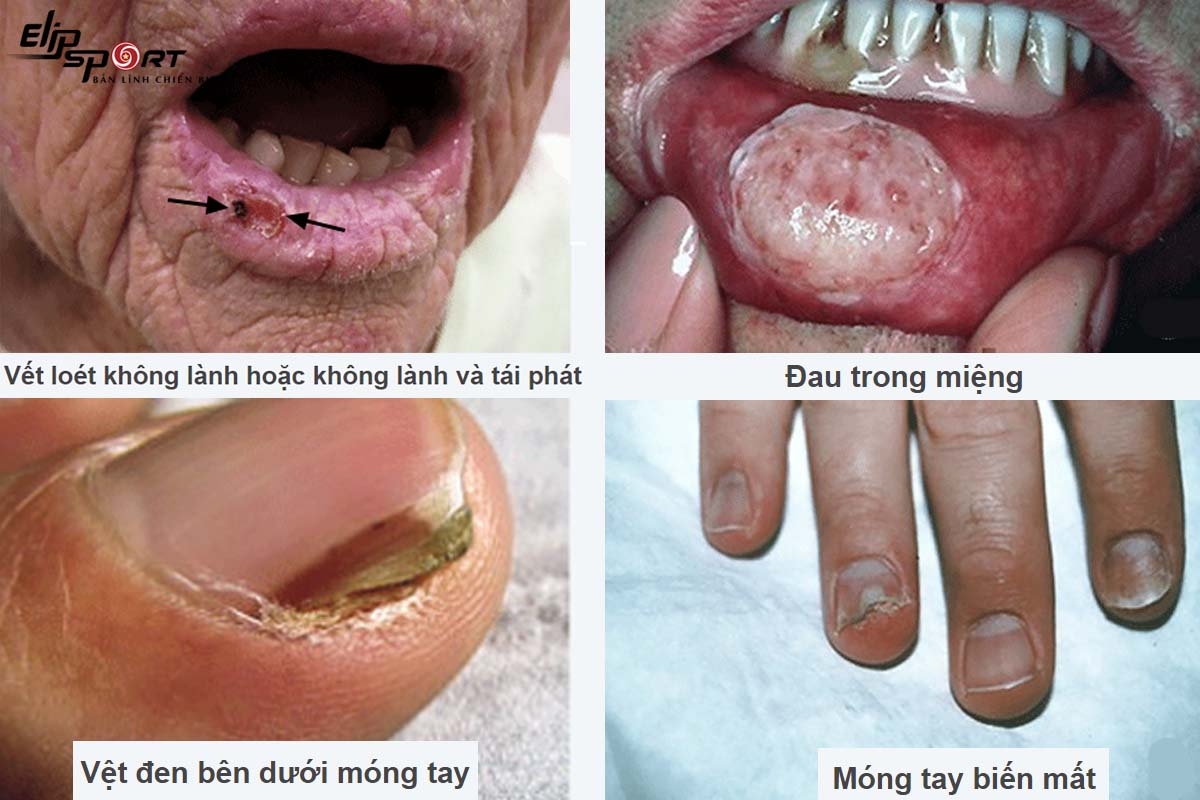 d&acirc;́u hi&ecirc;̣u cảnh báo ung thư da