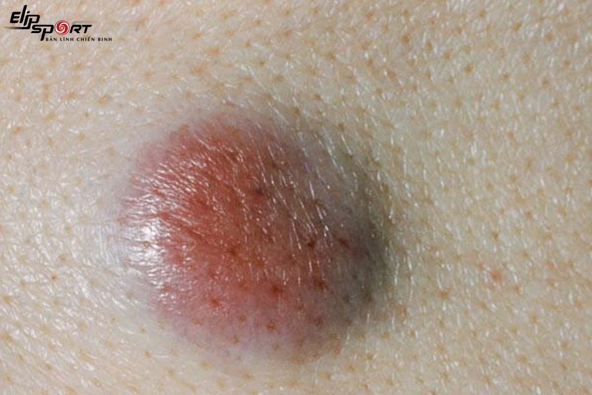 d&acirc;́u hi&ecirc;̣u cảnh báo ung thư da