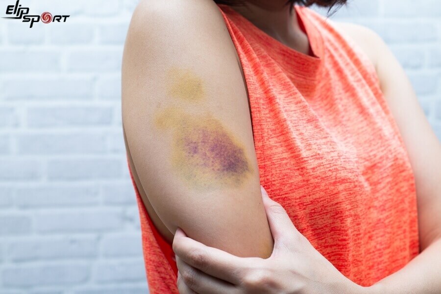 massage m&ocirc; s&acirc;u kh&ocirc;ng n&ecirc;n thực hiện ở vị tr&iacute; vết bầm