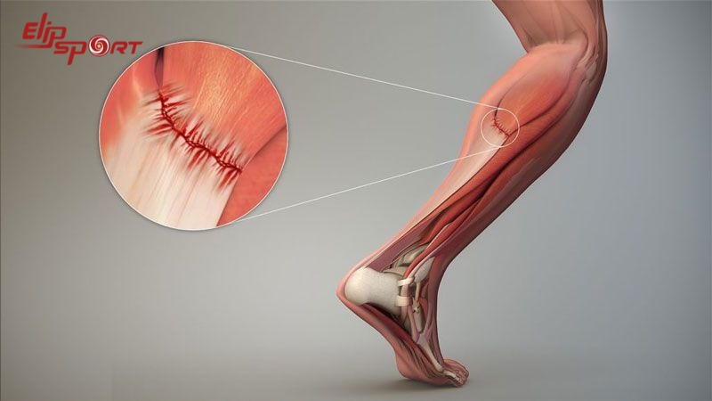 Căng bắp ch&acirc;n cũng l&agrave; một trong những chấn thương c&oacute; thể gặp