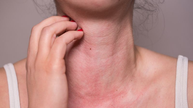 Nổi mẩn đỏ l&agrave; một trong những triệu chứng khi dị ứng với đậu que