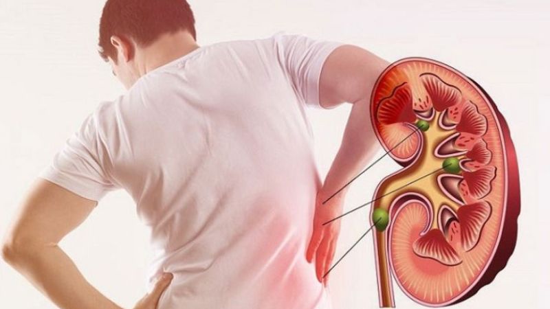 Người bị suy thận kh&ocirc;ng n&ecirc;n ăn quả na v&igrave; quả na c&oacute; chứa nhiều đường, natri v&agrave; kali