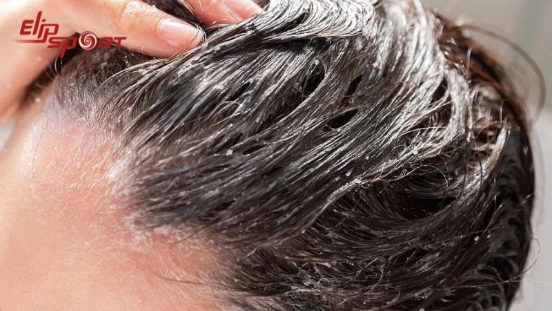 Việc sử dụng tẩy tế b&agrave;o chết da đầu từ 2 đến 3 lần mỗi tuần c&oacute; thể gi&uacute;p loại bỏ c&aacute;c tế b&agrave;o da chết