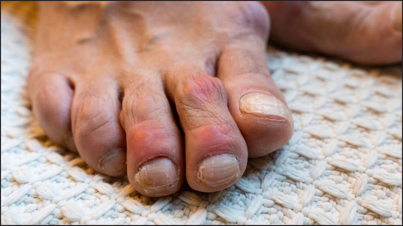 Hỗ trợ điều trị bệnh Gout