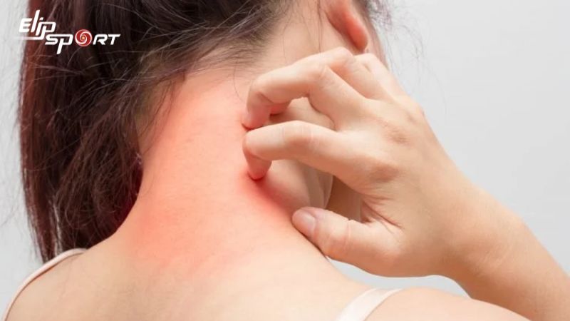 Dấu hiệu phổ biến của dị ứng c&aacute; thu l&agrave; da ngứa v&agrave; đỏ