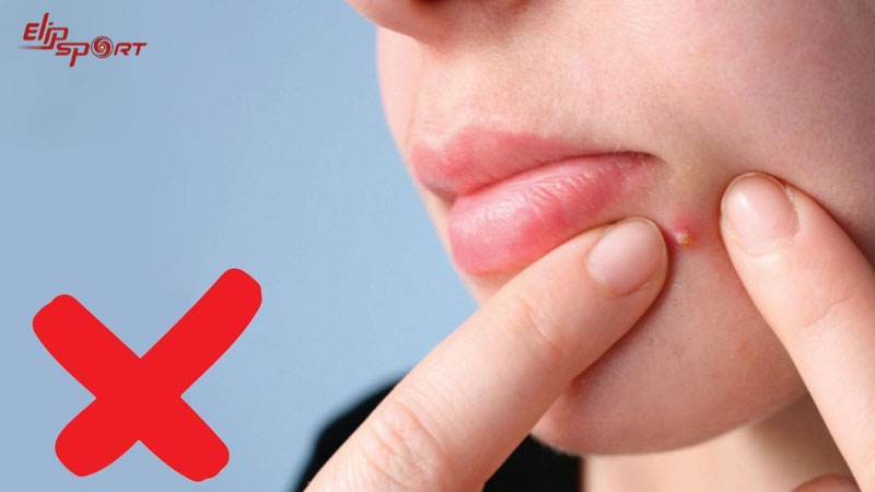 Nặn mụn khiến vi khuẩn c&oacute; thể l&acirc;y lan sang c&aacute;c v&ugrave;ng da xung quanh v&agrave; l&agrave;m nhiễm tr&ugrave;ng nặng hơn