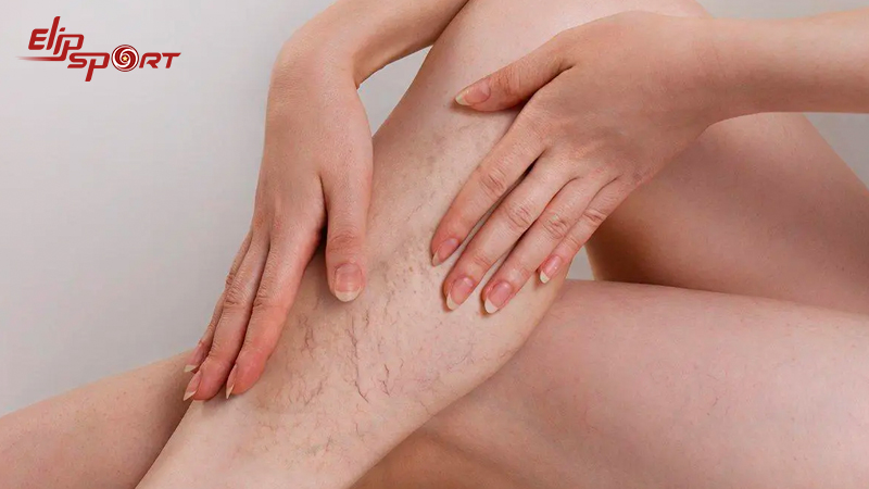 Bệnh suy gi&atilde;n tĩnh mạch c&oacute; thể dẫn đến c&aacute;c biến chứng nguy hiểm