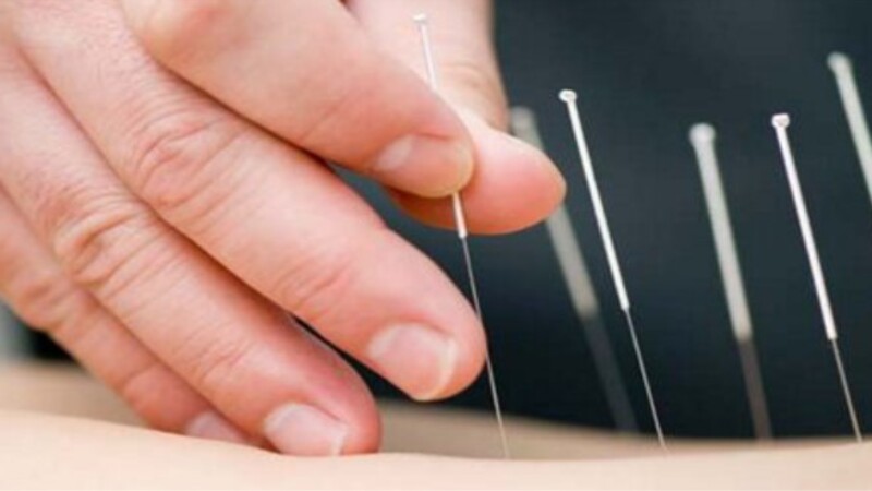 Ch&acirc;m cứu l&agrave; một phương ph&aacute;p truyền thống trong y học Trung Quốc