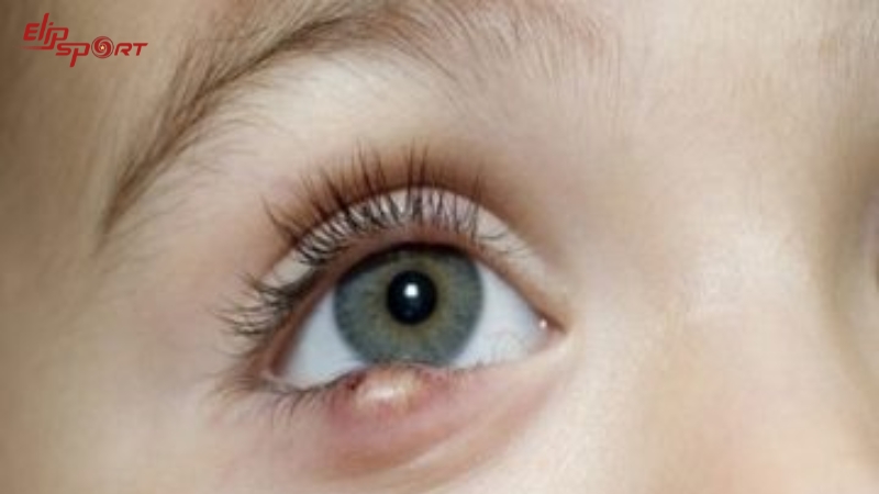 Vệ sinh mắt bằng nước muối sinh l&yacute; để ph&ograve;ng ngừa bệnh l&ocirc;ng mi mọc ngược