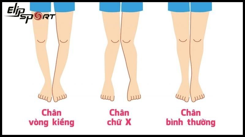 b&eacute; bị ch&acirc;n v&ograve;ng kiềng