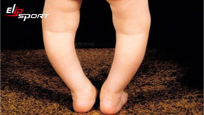 b&eacute; bị ch&acirc;n v&ograve;ng kiềng