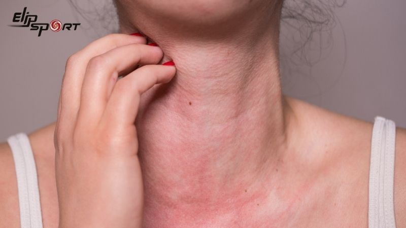 Đối với những người c&oacute; tiền sử dị ứng cần ch&uacute; &yacute; kh&ocirc;ng n&ecirc;n ăn khoai t&acirc;y qu&aacute; nhiều
