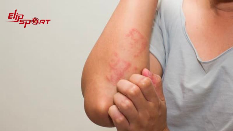 Người c&oacute; tiền sử dị ứng với bơ hoặc sữa kh&ocirc;ng n&ecirc;n ăn ph&ocirc; mai que
