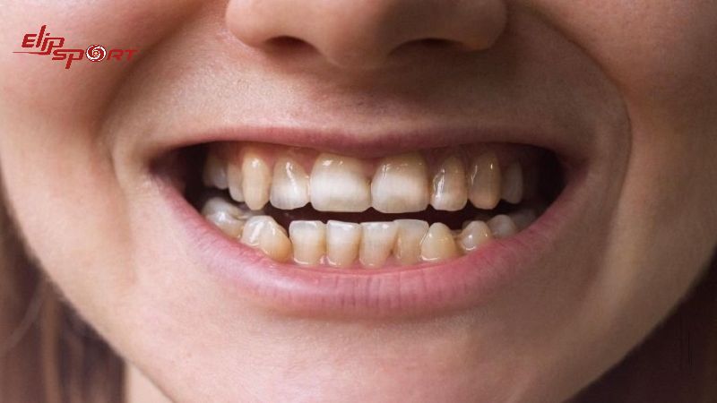 Axit c&oacute; trong c&aacute;c loại nước giải kh&aacute;t c&oacute; gas sẽ g&acirc;y m&ograve;n răng