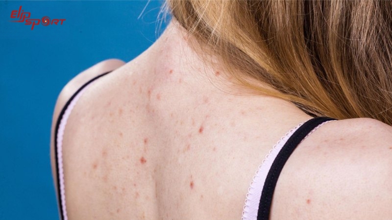 Nổi mụn cũng l&agrave; một t&aacute;c dụng phụ do uống mass sai c&aacute;ch