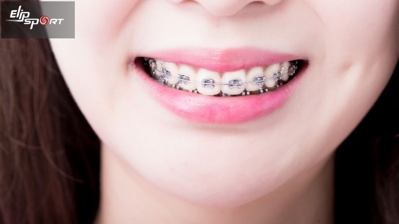 Thế n&agrave;o l&agrave; niềng răng?