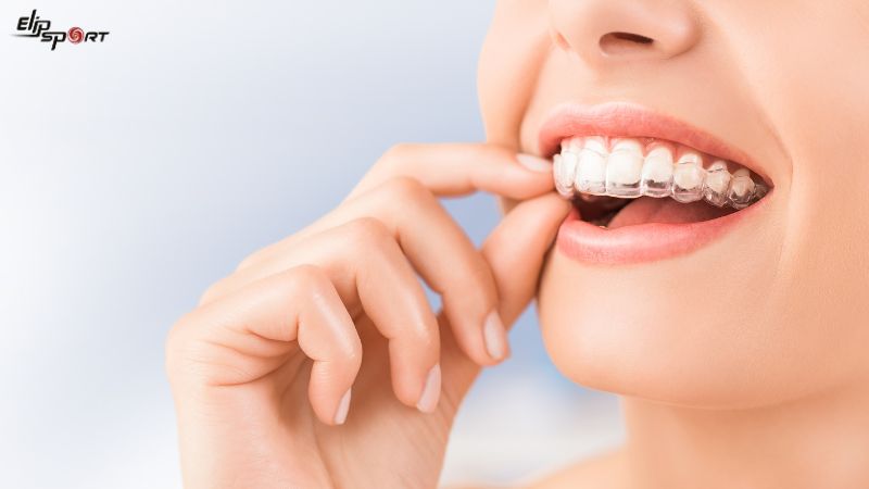 Ni&ecirc;̀ng răng kh&ocirc;ng mắc cài