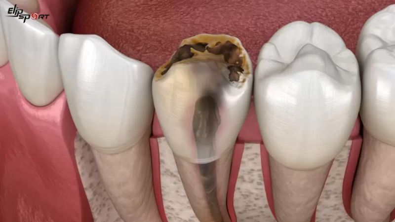 Niềng răng sai c&aacute;ch dẫn đến nhiều nguy cơ