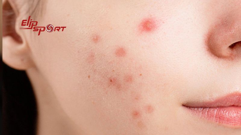 Nếu bạn ăn b&aacute;nh Nabati v&agrave; bị nổi mụn, th&igrave; rất c&oacute; thể nguy&ecirc;n nh&acirc;n l&agrave; do c&aacute;c yếu tố kh&aacute;c